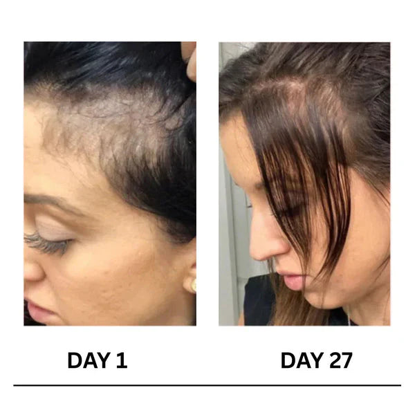 🔥Limited-Time 50% Offer !! 🌿Scalpy Boost+ Hair Growth